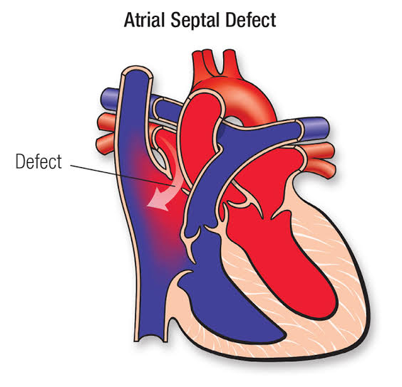 Atrial Septal Defect: Memahami Cacat Septum Atrium
